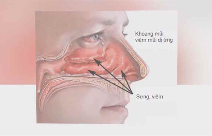 Sống khỏe 360 - Chữa viêm mũi họng xuất tiết như thế nào? (15-01-2020)